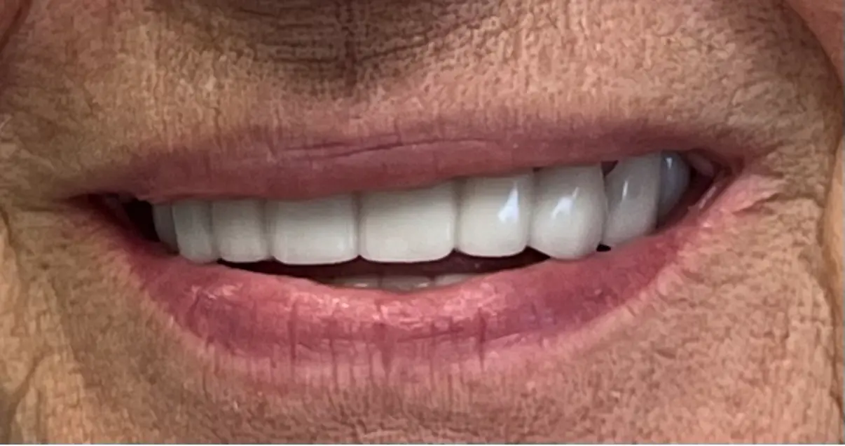 After treatment