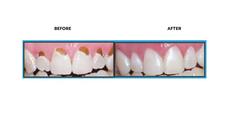 Tooth-Colored Fillings Rochester Hills, MI