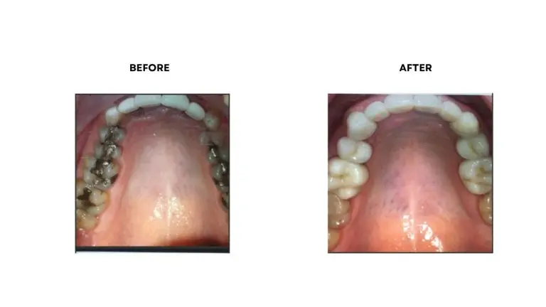 Tooth-Colored Fillings Rochester Hills, MI