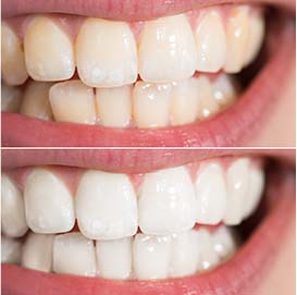 Teeth Whitening Rochester Hills Dentist 
