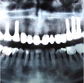 Implant restorations Dentist in Rochester Hills MI