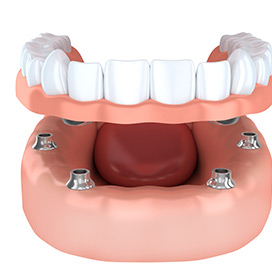Implant supported dentures Rochester Hills Dentist