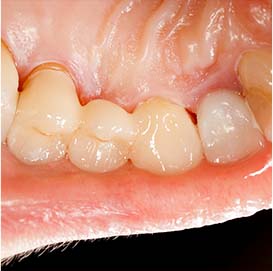 Dental crowns and bridges Rochester Dentist