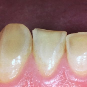 Teeth Before Dental Veneers Rochester Hills Dentistry