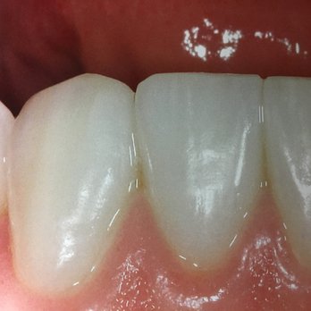Teeth After Dental Veneers Rochester Hills Dentistry