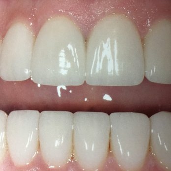 Teeth After Dental Veneers Rochester Hills Dentist