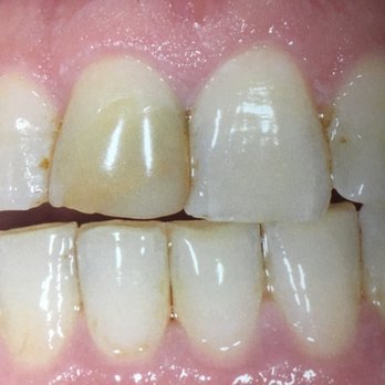 Teeth Before Dental Veneers Rochester Hills Dentistry