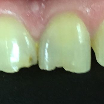 Teeth Before Dental Bonding Rochester Hills Dentist