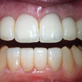 Dental Crowns After Rochester Hills Dentist MI