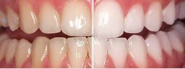 Teeth Whitening Before and After Dentist in Rochester 