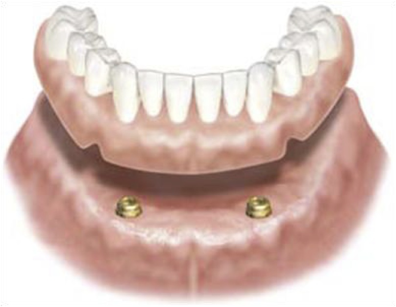 Implant-Supported Dentures Rochester Hills