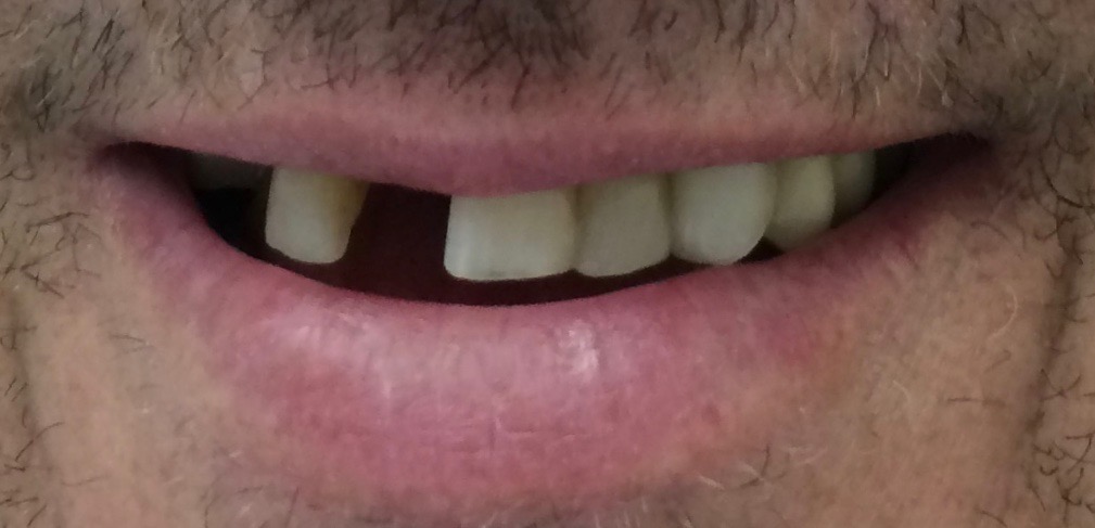 Snap-On Smile® Before Rochester Hills Dentist