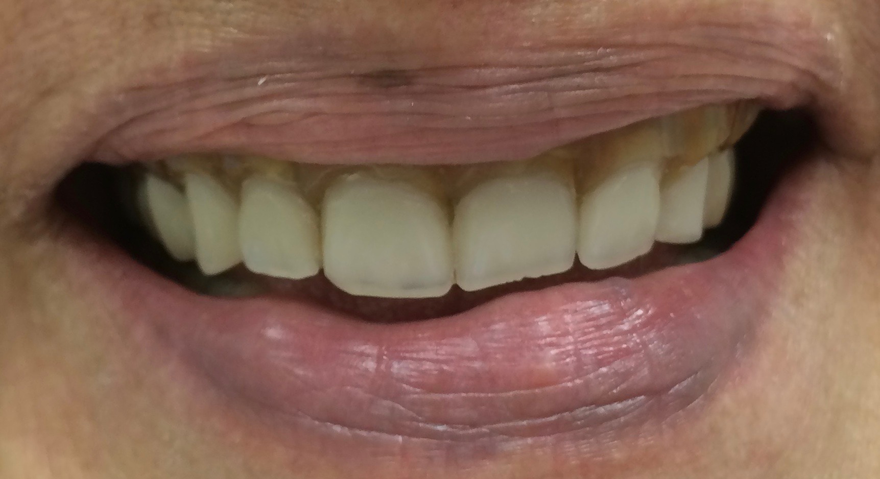 Complete Upper Denture Before Rochester Hills Dentist