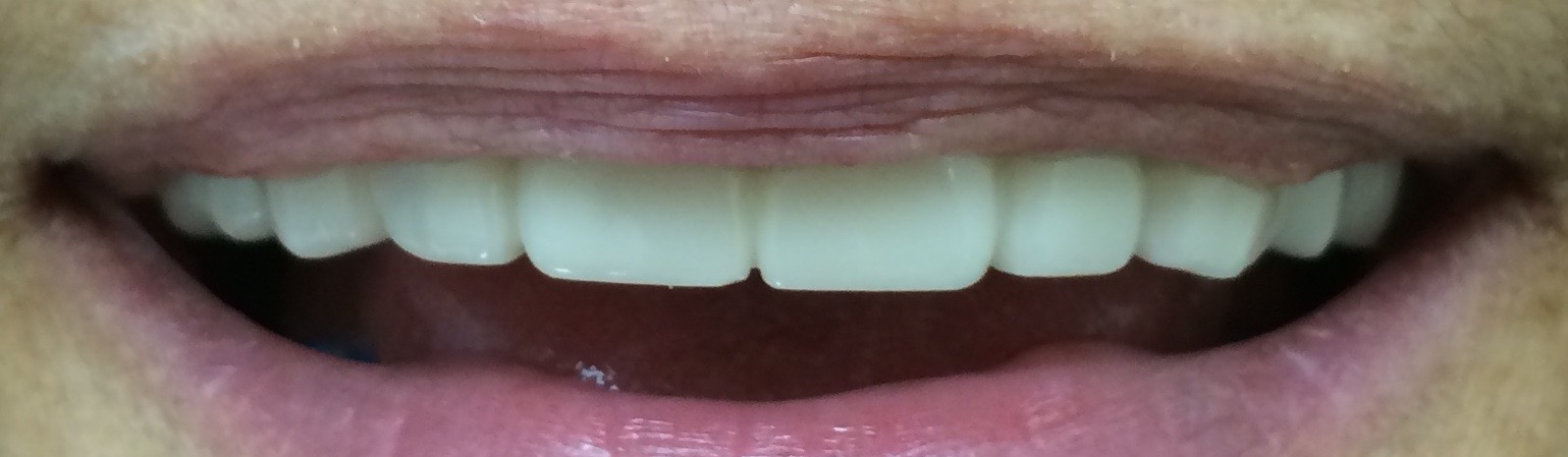 Snap-On Smile® After Rochester Hills Dentist