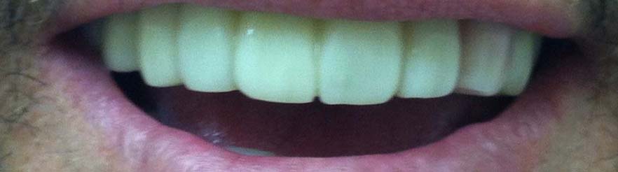 Snap on Smile® After Rochester Hills Dentist MI 2