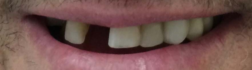 Snap on Smile® Before Rochester Hills Dentist MI 2