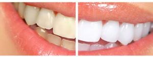 before and after teeth whitening service