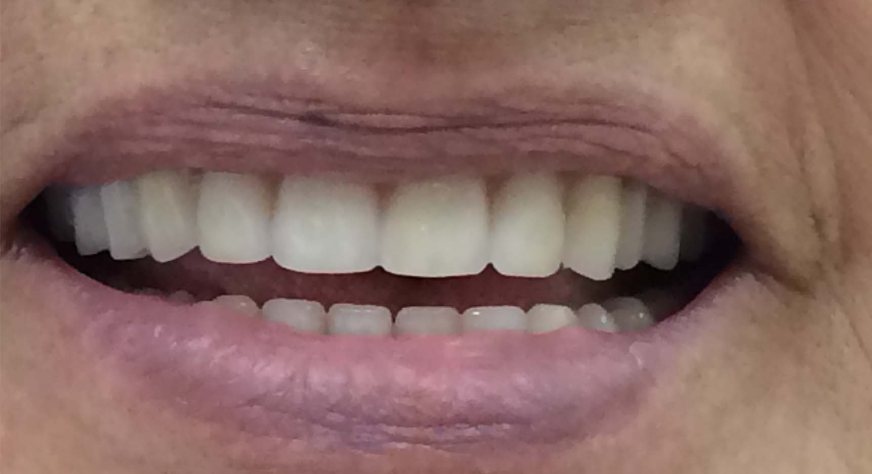 Complete Upper Denture After Rochester Hills Dentist