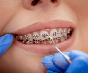 Dental Braces Treatment Rochester Hills
