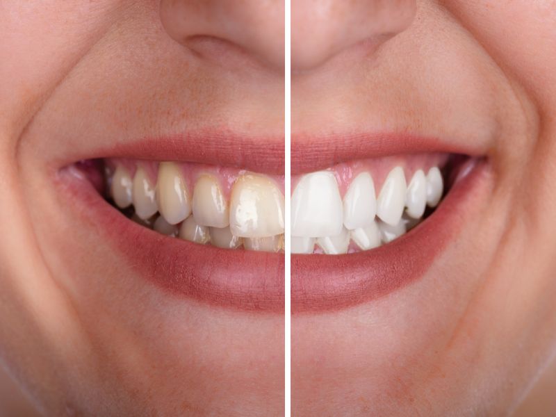 Teeth whitening Rochester Hills